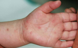 26.000 ca tay chân miệng, nguy cơ gia tăng trong thời gian tới