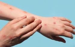 Trong 1 tuần TP HCM phát hiện thêm 15 ca đậu mùa khỉ