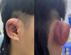 Nhiễm trùng, hoại tử sụn do bấm nhiều lỗ tai