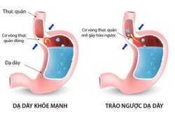 Bệnh trào ngược dạ dày - thực quản: 5 biến chứng nguy hiểm