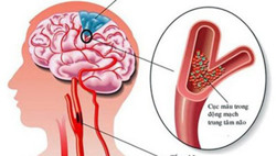Dấu hiệu khi bạn bị thiếu máu não