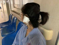 Cảnh báo áp xe vành tai sau bấm khuyên