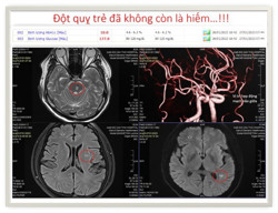Cảnh báo với bệnh cứ 5 người thì 1 mắc