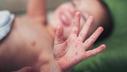 Đề phòng một số bệnh trẻ em dễ mắc vào mùa hè