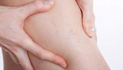 Suy giãn tĩnh mạch - bệnh không của riêng ai