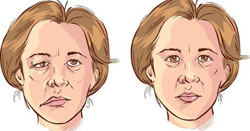 Tắm đêm có phải thủ phạm gây liệt dây thần kinh số 7?