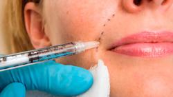 Những vùng da nào không được tiêm filler?