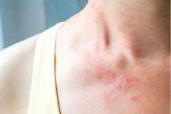 Những cách giúp hạn chế tác nhân gây viêm da dị ứng trong mùa lạnh
