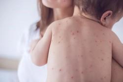 Thủy đậu vào mùa - Làm gì để phòng bệnh?
