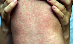 Ca mắc sởi tăng gần 3 lần, bệnh sởi có dễ lây?